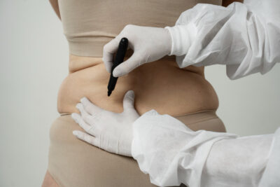 Liposuction Surgery in Bangalore